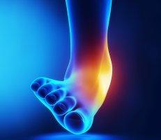 Ankle Sprain