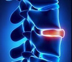 Herniated Disc