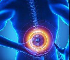 Radiculopathy