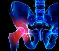 Sciatica