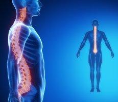 Scoliosis