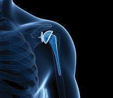 Shoulder Pain
