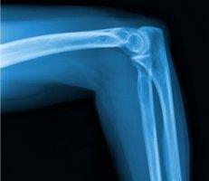 Tennis Elbow